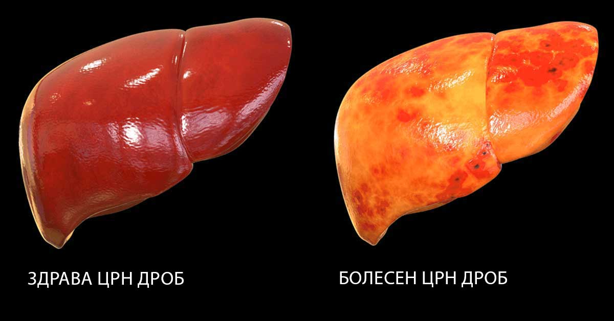 Алкохолни заболувања на црниот дроб